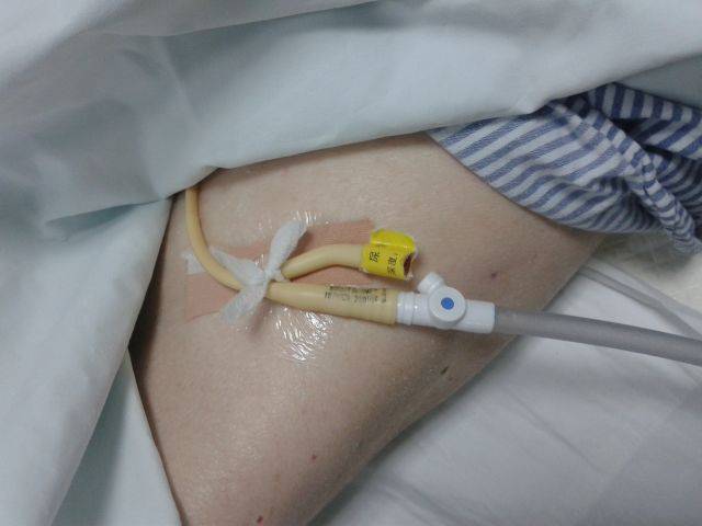 妇科手术导尿管护理