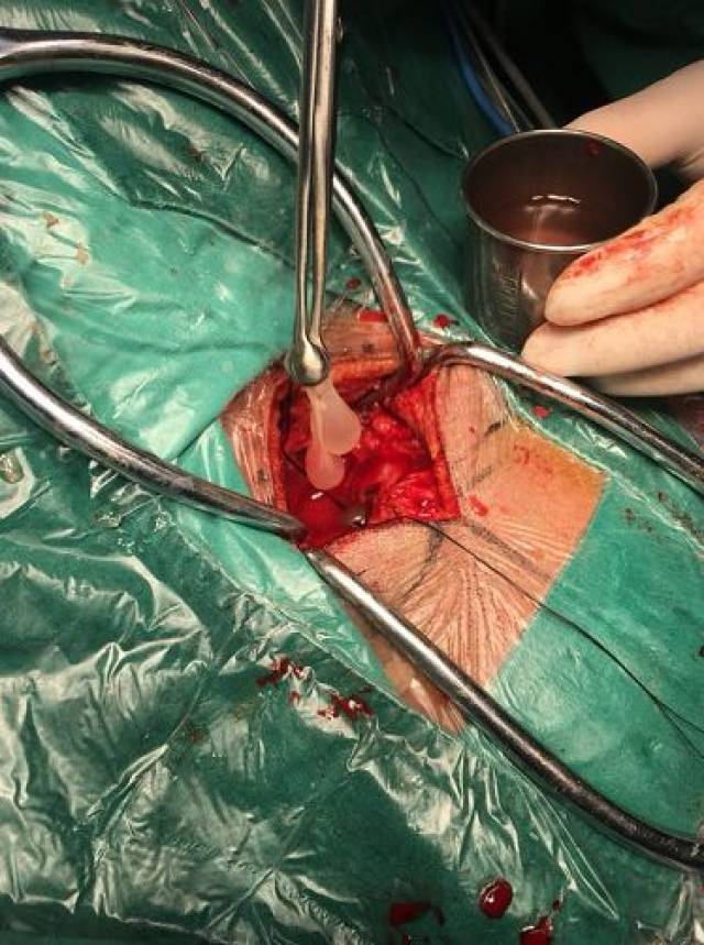 据了解,脑囊虫病,与我们熟知的蛔虫,蛲虫等常见病相似,都属于人体寄生