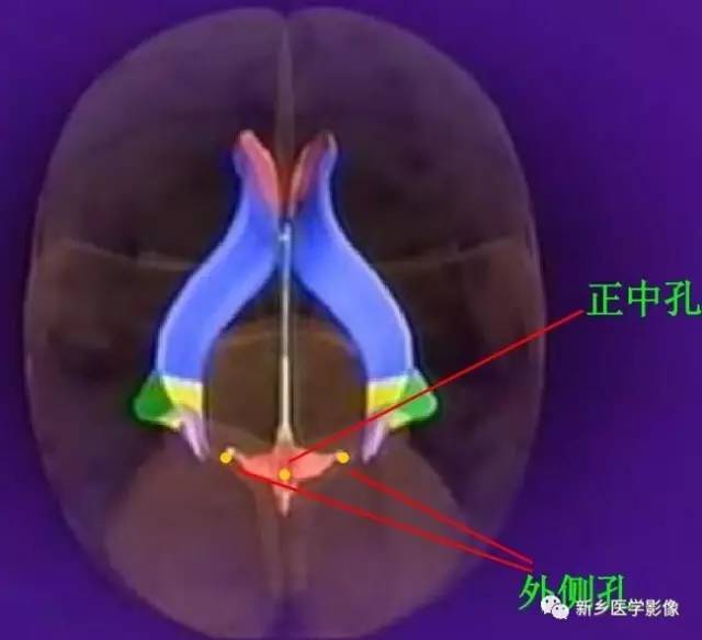 于脑室底部(菱形窝)侧角及下角有孔,称第四脑室侧孔及中间孔,与蛛网膜