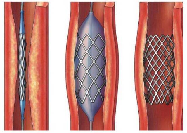 突发心梗后自我溶栓治疗,这个乡下护士太强了