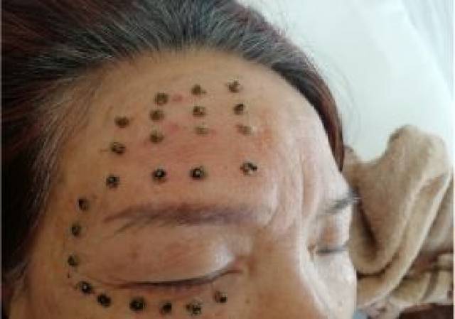 小小麦粒灸,灭了你个歪嘴风