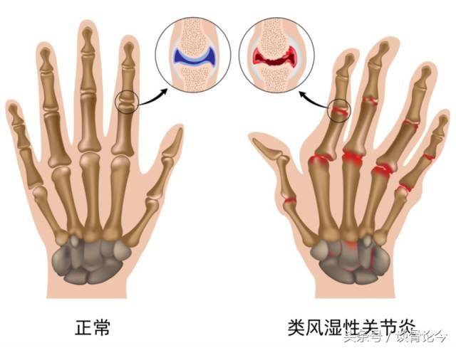 如果你有这十大特征,说明你离风湿性关节炎不远了