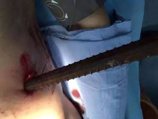 【封面】长约150cm钢筋穿过男子腹部!市中心人民医院多学科接力抢救