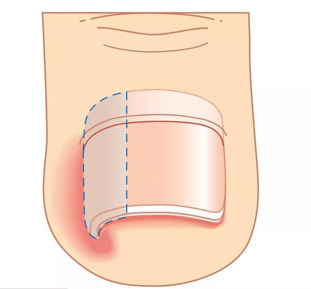 如何摆脱疼痛难忍的嵌甲