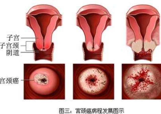 宫颈癌症状图片