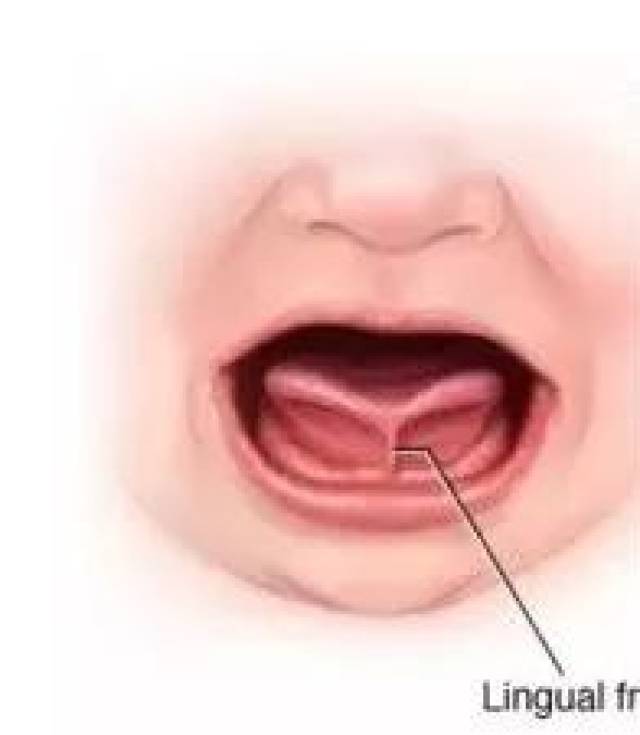 婴儿舌头粘连图片图片