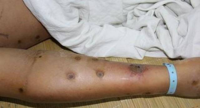 农妇被毒蜂围攻致过敏性休克!蜂蜇伤如何急救?