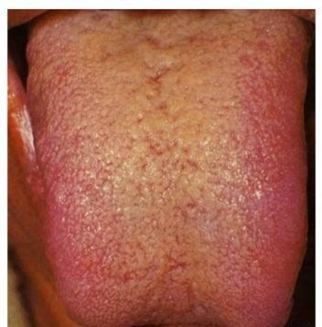 舌苔发黄,疾病可能正在潜伏!六种不同的症状看看你是哪一种?