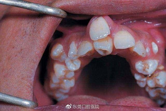 恒牙已萌出,相应乳牙未脱落,叫做乳牙滞留,俗称双排牙