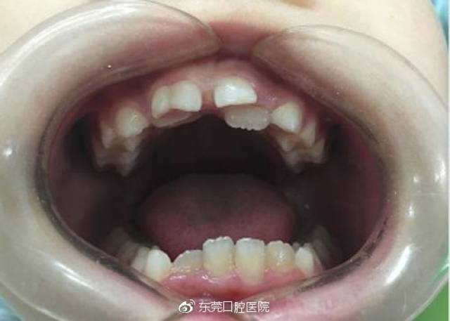 小女孩还张开嘴给我看看她的牙,原来是到了换牙期了,旧的牙齿还没有