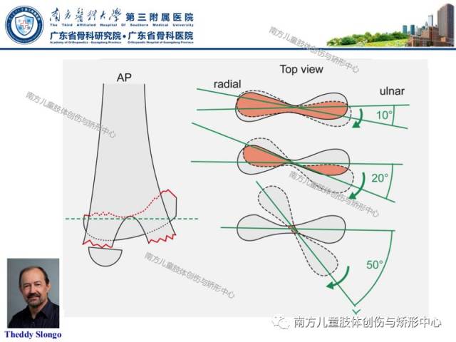 小儿肱骨髁上骨折的治疗策略