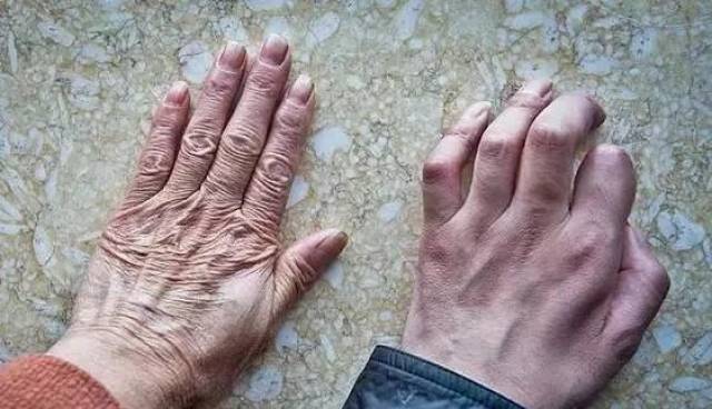 我们真的拿渐冻症没有办法吗?