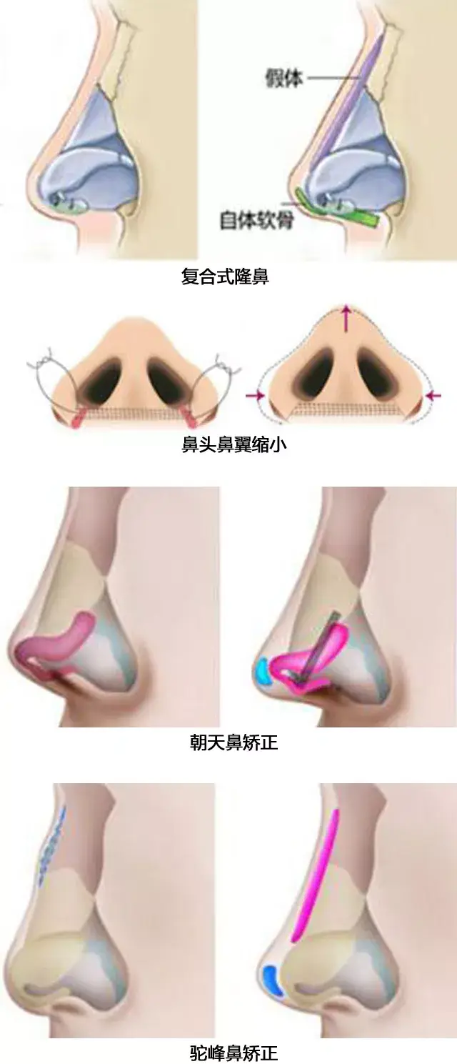 鼻综合隆鼻