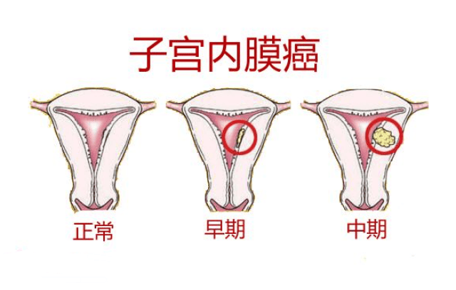 这5大子宫疾病