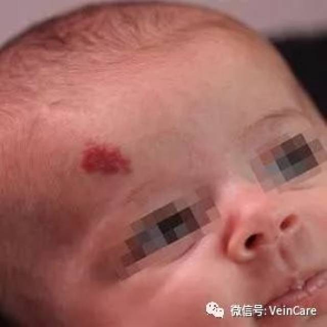 血管瘤专科医院的关注焦点：科技与人文并重