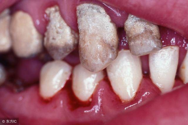 刷牙能把口腔细菌,残渣等彻底清理干净吗?