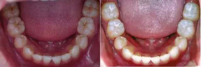 儿童牙齿涂氟前后图片图片