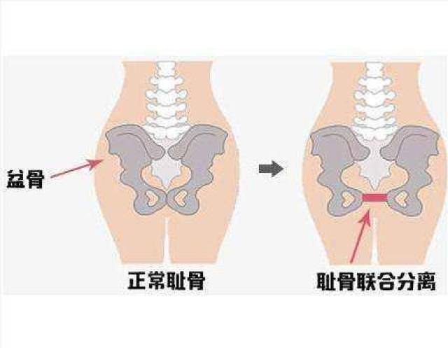 耻骨是哪个位置 真人图片