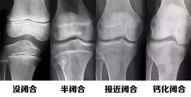 骨骺线膝盖图片