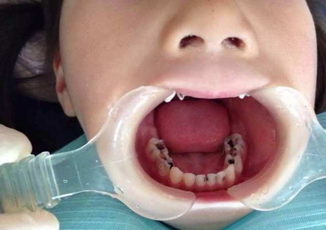 儿童臼齿龋齿图片