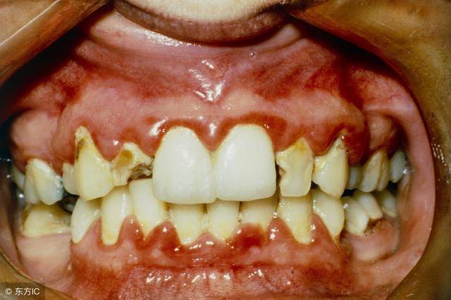 艾滋病患者的牙龈图片图片
