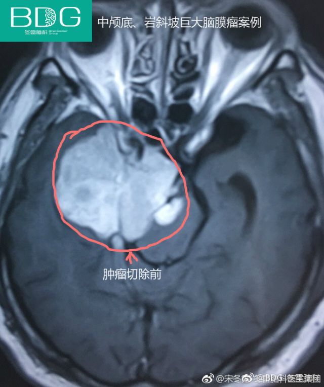 譬如長的太硬了,手術不好切. 性質變了.檢查出來是腦膜瘤,但是惡變