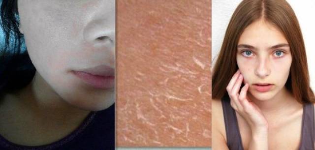 初春怎么拯救你的大干皮!