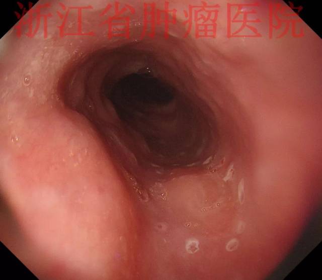 食管下段贲门癌图片图片