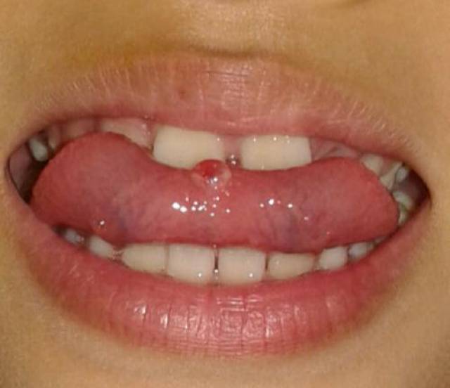 口腔内壁有红血点图片图片
