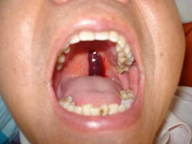 口腔内有血泡是什么原因?可能是这个大问题
