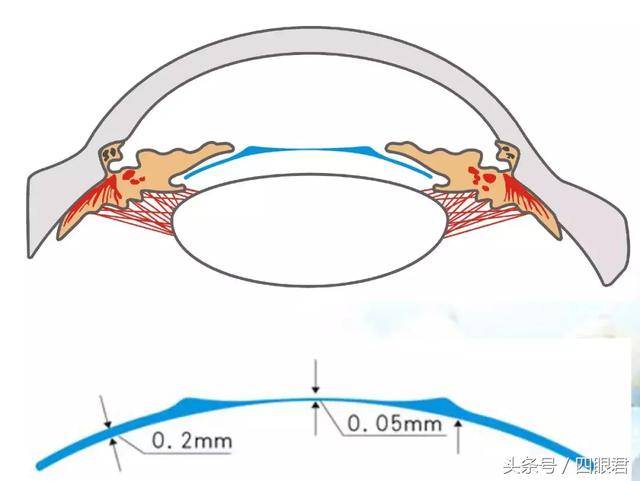 0d～-30.0d;屈光稳定,术前矫正视力0.3以上;前房深度≥2.