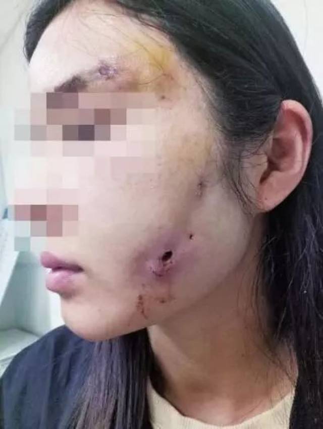 可怕!商丘一女子整容后脸上溃洞流脓,还被店主,手术医生拉黑