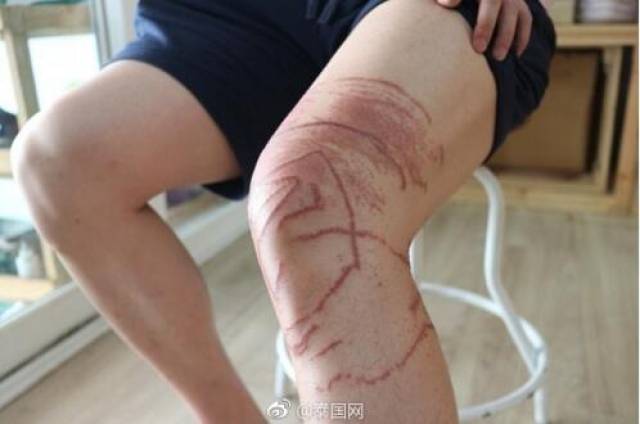 泰国男子被水母蜇伤,伤痕太恐怖!