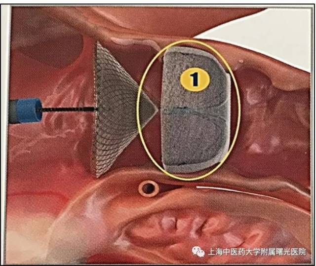 【曙光·新闻】我院心内科成功开展经皮左心耳封堵术