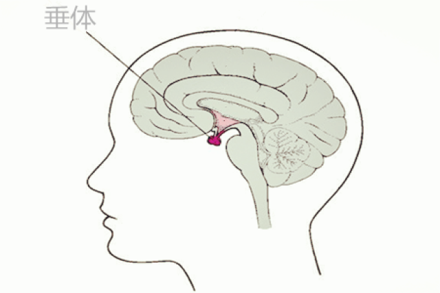 千万警惕脑垂体瘤!