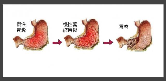 胃癌前状态:萎缩性胃炎,表现有五种症状