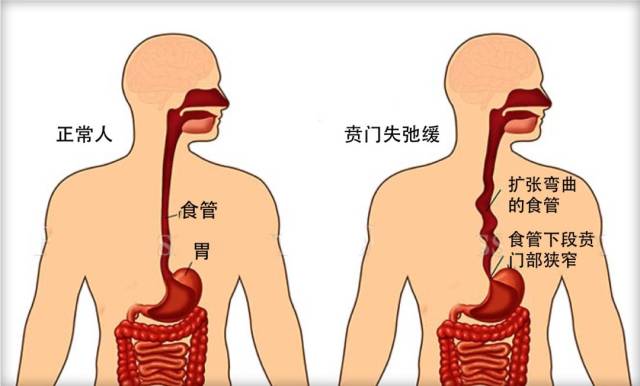 贲门失驰缓的常用定义是食管的下括约肌不能松弛,食管蠕动消失.