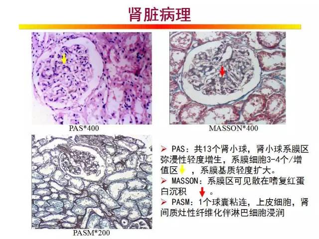 精彩幻燈 | iga腎病合併乙肝病例分享