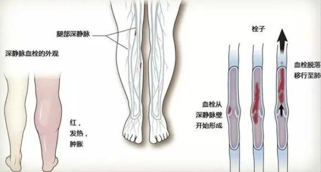 下肢静脉血栓解剖图图片