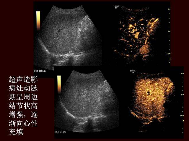 超声造影提高原发性肝癌的诊断灵敏度