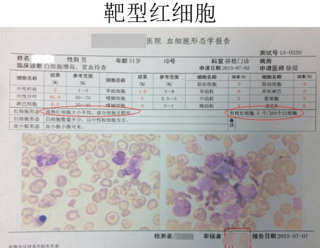 回顾患者的血常规,发现即使是在病人血红蛋白正常的时候,红细胞平均