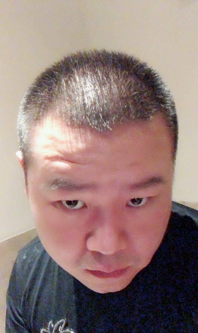 只见照片中的岳云鹏头发稀疏,脱发略微严重