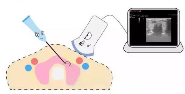 【新技术】我院成功实施全市首例甲状腺肿块微波消融术