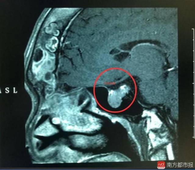脑垂体位置明显膨大