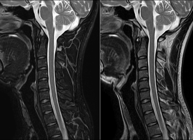 (脊柱)神经外科医师一般主张做颈椎核磁共振(mri)来判别患者颈椎的
