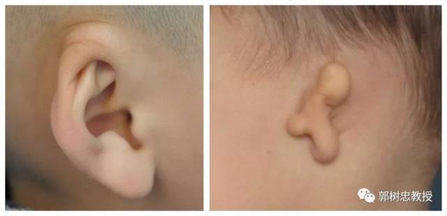 先天性小耳畸形的父母当第一次看到孩子只有一个很小的腊肠样的耳朵