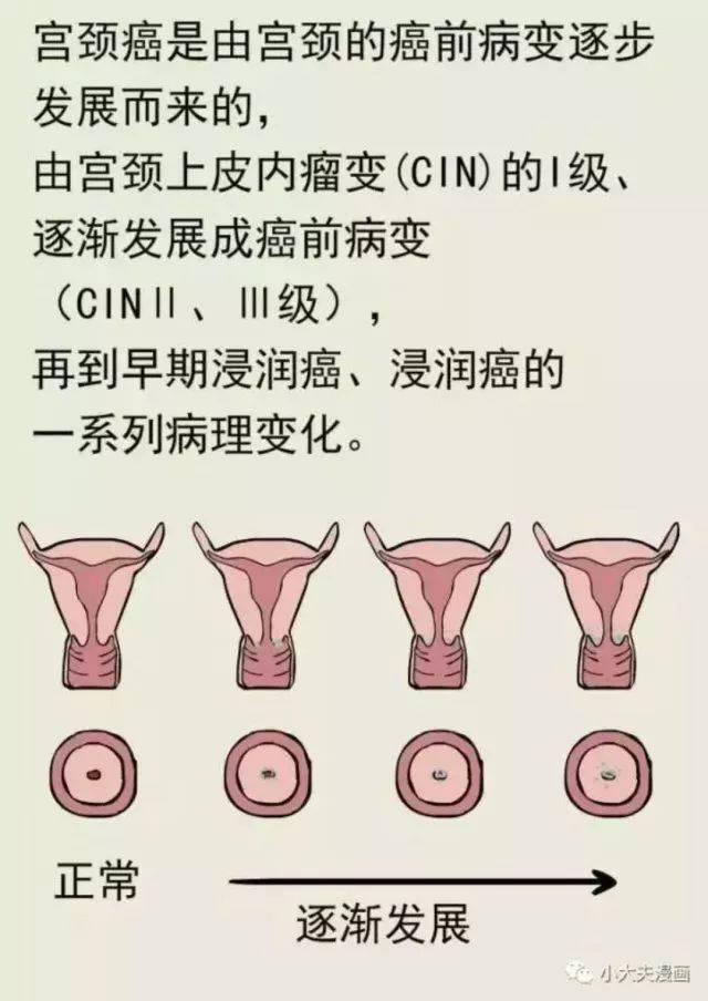 HPV感染癌变图片