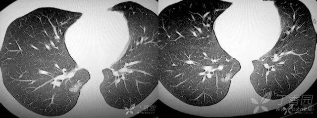 肺炎性假瘤ct表现图片