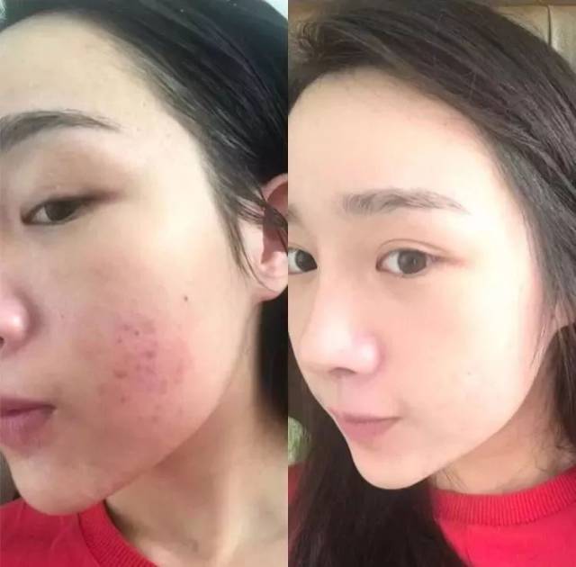 自带遮瑕效果的祛痘药膏,消闭口又遮痘印~日本妹子原来都用它!