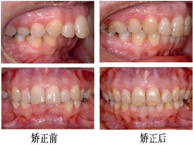 龅牙矫正全过程图片